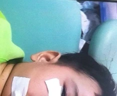 Bé 3 tuổi bị chó Phú Quốc cắn phải khâu 200 mũi trên mặt.