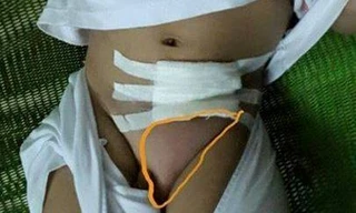 Bé trai 2 tuổi bị mổ “oan” tại Bệnh viện Nhi đồng Đồng Nai do chẩn đoán nhầm.