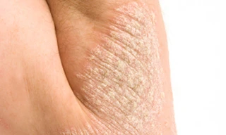 Bệnh vẩy nến cần dầu gội dành riêng