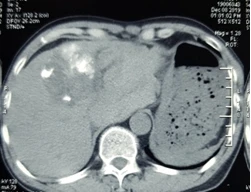 Cụ ông vỡ u gan, máu tràn ngập ổ bụng mà không hề biết