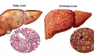 Những dấu hiệu cảnh báo gan có thể bị nhiễm độc, đi khám ngay kẻo 'muộn'