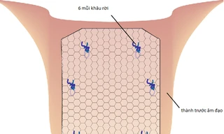 'Đoạn tuyệt' với sa sinh dục - bàng quang nhờ kỹ thuật nội soi hiện đại