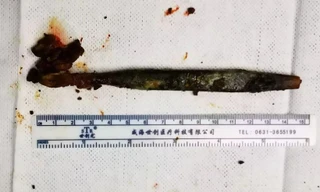  Chiếc bàn chải đã được lấy ra khỏi ổ bụng của Li. Ảnh: AsiaWire