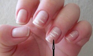 Dấu hiệu từ móng tay cảnh báo bệnh về gan, khớp, thậm chí ung thư