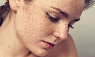 Những bộ phận trên cơ thể rất dễ bị ung thư da nhưng ít ai để ý