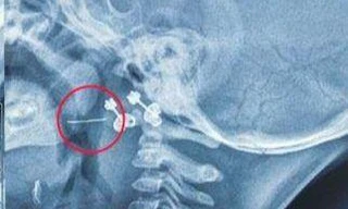 Bé gái 13 tháng bị dây thép đâm xuyên amidan vì lý do không ngờ