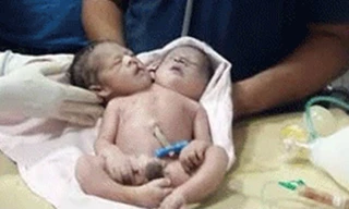 Cận cảnh đứa trẻ có 2 đầu 3 tay