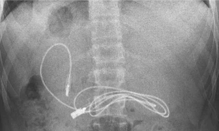 Đau bụng dữ dội vì dây sạc và chun buộc tóc trong dạ dày 