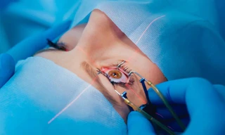 Mỹ: Tranh cãi về việc mổ mắt laser LASIK 