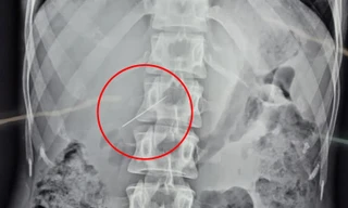 Người phụ nữ sống sót hy hữu sau khi kim khâu lọt vào gan