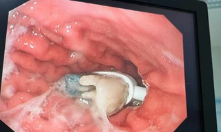 Nuốt bàn chải đánh răng, cậu bé 9 tuổi suýt tắc ruột 