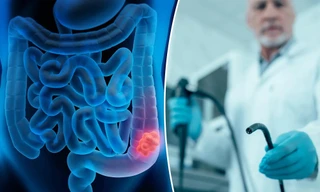 Nghiên cứu mới: Nội soi đại tràng có thể không hiệu quả như mong muốn 