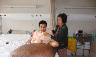 Người mang khối u khổng lồ đã qua đời