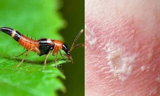 Nhận biết và xử lý tổn thương do độc tố từ kiến ba khoang