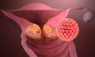 Hiểu về HPV - virus lây qua đường 'yêu' phổ biến nhất hiện nay
