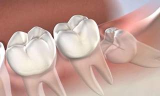 Tại sao con người có răng khôn?