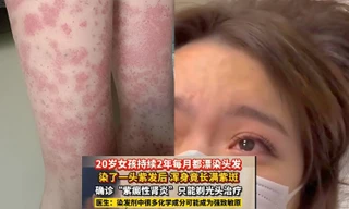 Nhuộm tóc liên tục suốt hai năm, cô gái ở Trung Quốc phải cạo đầu vì suy thận