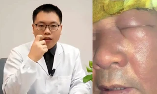 Người đàn ông ở Trung Quốc mặt sưng phù vì nhiễm khuẩn do thói quen ngoáy mũi