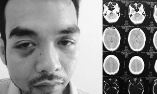 Đường Quang Anh đã bị một nhóm côn đồ dùng gậy chơi bi–a vụt khiến khuôn mặt bị biến dạng