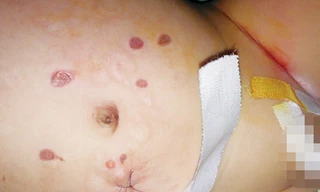 Trẻ suýt mất mạng vì lang băm