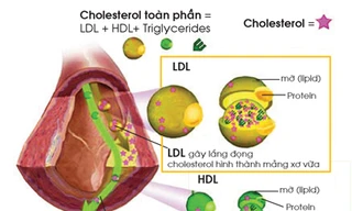 Rối loạn mỡ máu dẫn đến cơn đau thắt ngực