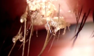 Cô Zhang vô cùng hoảng hốt khi biết chấy ký sinh trên mi mắt mình