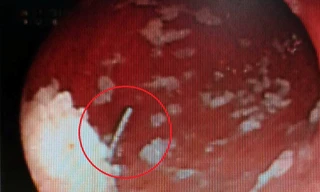 Đùa giỡn với bạn, nam thanh niên nuốt cả kim may vào bụng