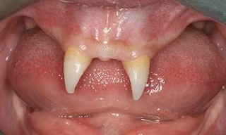 Cậu bé mọc răng như ma cà rồng