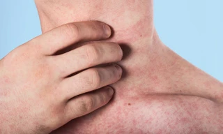 Gia tăng ca mắc sởi: Bác sĩ chỉ cách nhận biết và phòng ngừa các biến chứng 