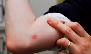 Cẩn trọng với bệnh da liễu khi thời tiết nồm ẩm