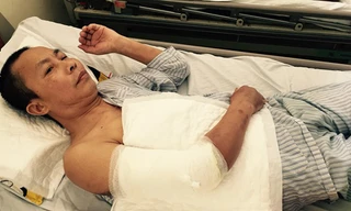 Cánh tay phải của bệnh nhân Hoàng Văn Nhân đã bị cắt đi phần da hoại tử.