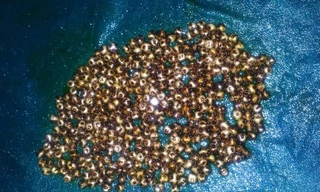 Những viên sỏi nhỏ trong túi mật bà Mousumi Dam. Ảnh: Cover Asia Press.