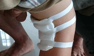 BS tự ý mổ chân phải bé Hào không thông báo gia đình.