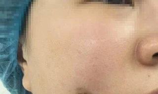 Người phụ nữ bị nhiễm trùng sau khi làm má lúm đồng tiền