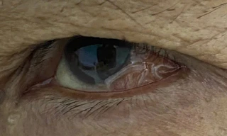 Phát hiện giun dài 14cm 'tung tăng' trong mắt người