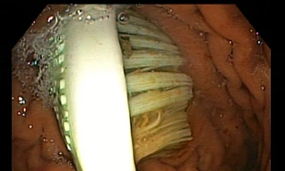 Nữ sinh viên nuốt cả bàn chải vào bụng vì trượt chân ngã khi đánh răng