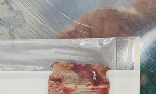 Thanh Hoá: Người đàn ông ruột lòi ra ngoài vì lưỡi cưa văng vào ổ bụng