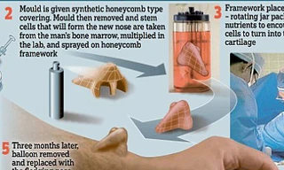 Chiếc mũi được tái tạo trên... cánh tay của người đàn ông 56 tuổi