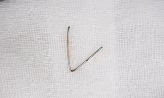 Lấy thành công đoạn kim loại 7cm trong cổ họng bé gái 5 tuổi