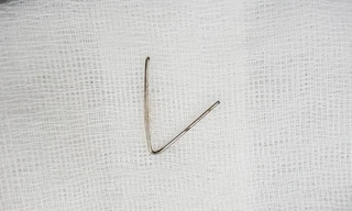 Lấy thành công đoạn kim loại 7cm trong cổ họng bé gái 5 tuổi