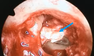 Bé gái suýt bị điếc vì khối cholesteatoma ăn mòn xương con trong tai giữa