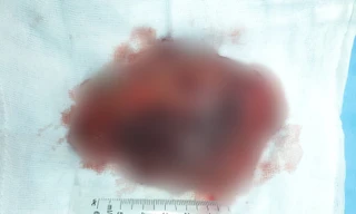 Sau chấn thương, cô gái 'mọc bướu' khủng lồ trên xương cánh tay