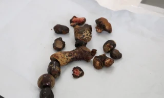 Bác sĩ chườm nước đá lấy sạch sỏi san hô trong thận nam bệnh nhân