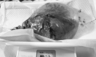 Cắt bỏ khối u nặng hơn đứa trẻ sơ sinh nằm trong tử cung người phụ nữ