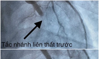 23 tuổi, nam thanh niên đột quỵ vì hút thuốc và nhậu trong nhiều năm