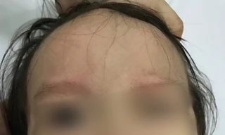 Bé gái 17 tháng tuổi đột ngột liệt mặt sau khi chảy mũi, ngạt mũi