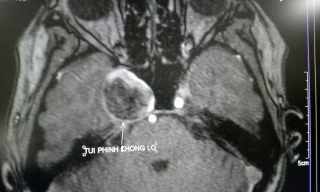 Cứu cụ bà có túi phình não khổng lồ mà không cần phẫu thuật