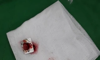 Hi hữu, người đàn ông bị kẹt vỏ thuốc trong khí quản suốt một năm