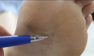 Thiếu nữ suýt mất mạng vì một vết ong đốt