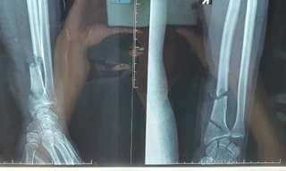 Dùng máy cưa tỉa cây, người đàn ông bị cắt đứt gần lìa cổ tay và cổ chân